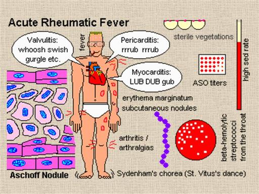 subcutaneous nodules rheumatic fever